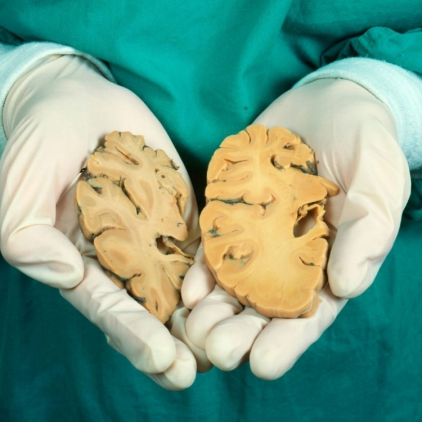 Alzheimer: cómo combatir la enfermedad que afecta a millones de personas