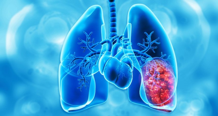 La promesa de una vacuna en cáncer de pulmón: “Hay indicios de que el ensayo pasará rápidamente a la fase II”